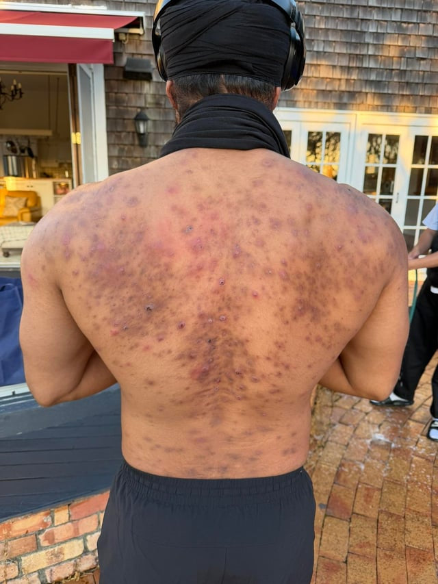 severe-back-acne-v0-o74mktdvbopg1.jpg__PID:73c0ce53-7034-4b08-bd11-5034594c30e7